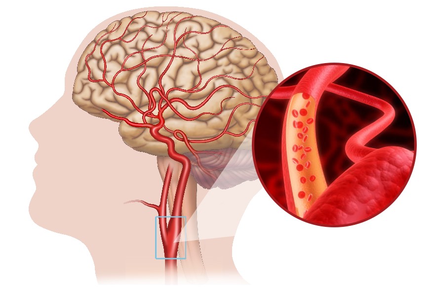 Rối loạn tuần hoàn máu não